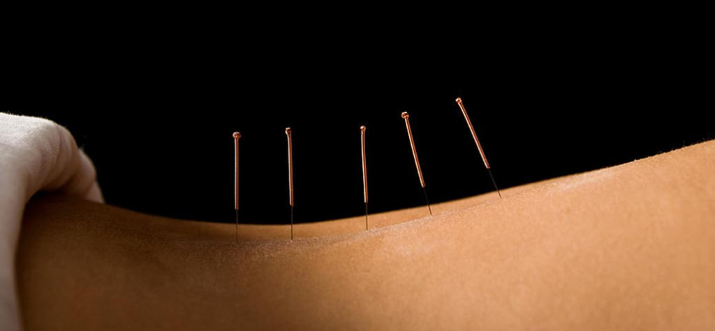 acupuncture for back pain