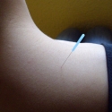 Acupuncture Needle on Shoulder Muscle