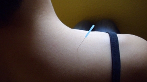 Acupuncture Needle on Shoulder Muscle