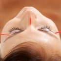 facial acupuncture