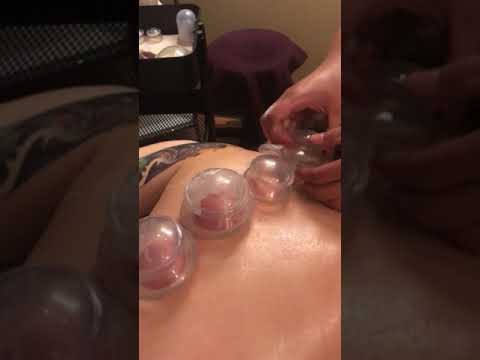 cupping and massage edmonton